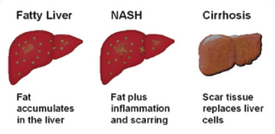 Fatty Liver Disease - Gastroenterology Consultants Of San Antonio