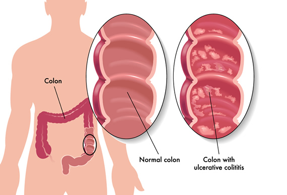 Ulcerative Proctitis, Ulcerative Colitis