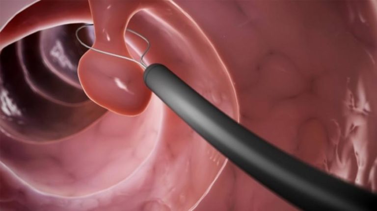 the-large-colon-polyp-when-to-choose-emr-esd-or-full-thickness