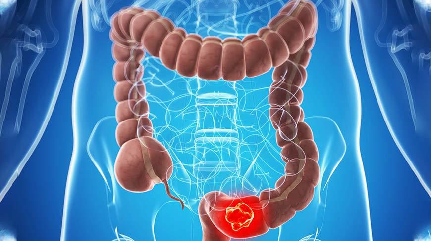What You Need To Know About The Stages Of Colon Cancer Gastroenterologist San Antonio