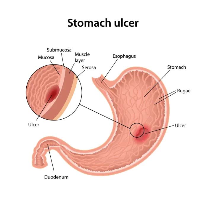 duodenal ulcer pain location