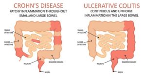 Crohn's Disease | An Ultimate Guide (Symptoms, Diet, Causes, Treatment)