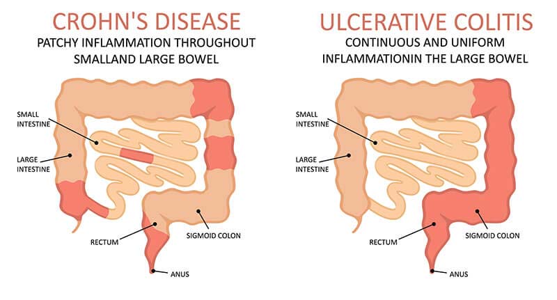 Crohn's Disease - Symptoms and Causes